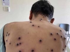 Casos de Mpox chegam a 140 no Brasil em 2026, aponta Ministério da Saúde